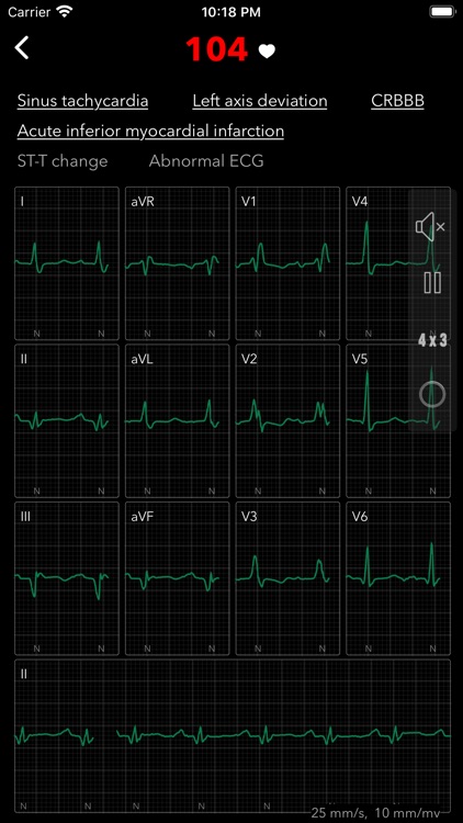 ECG / EKG