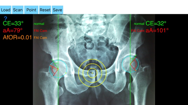 FemoroAcetabularImpingementApp screenshot-5
