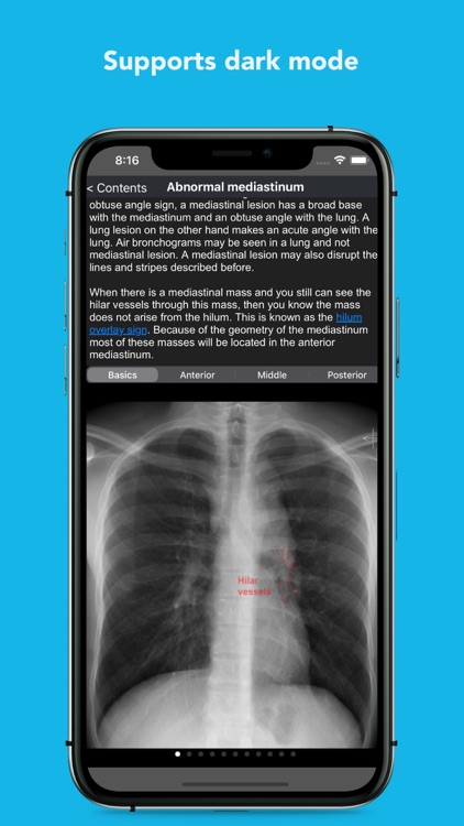 iCXR - Chest xray manual screenshot-5