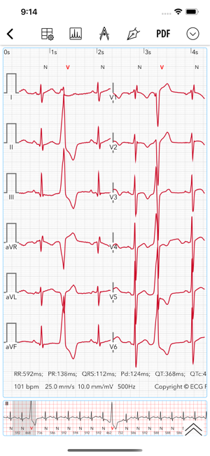 ECG / EKG(圖1)-速報App