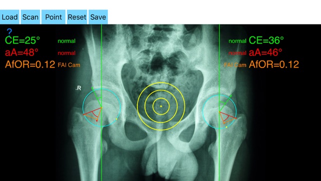FemoroAcetabularImpingementApp(圖5)-速報App