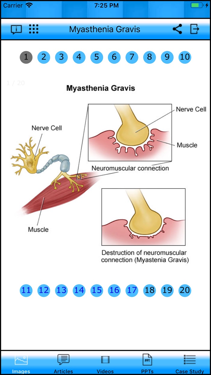 Myasthenia Gravis