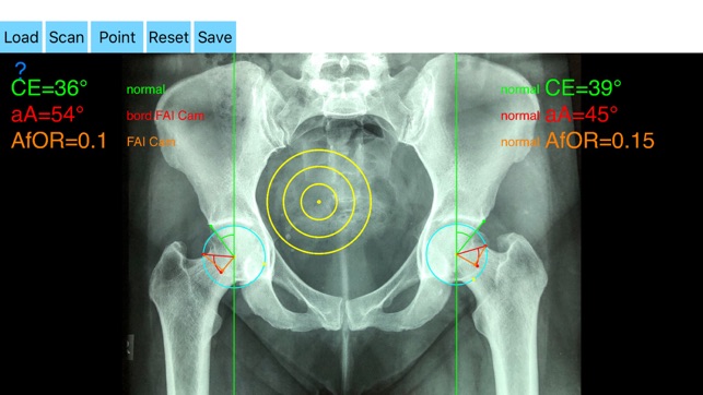 FemoroAcetabularImpingementApp(圖2)-速報App