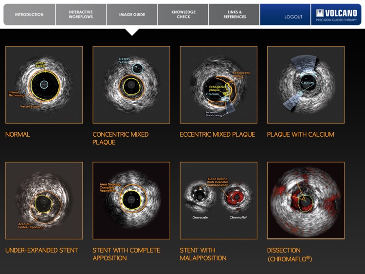 Coronary IVUS Essential Training screenshot-4