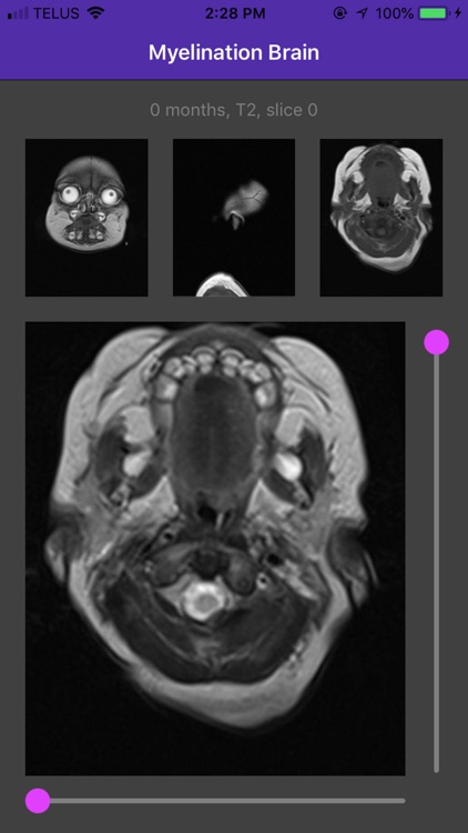 Myelination Brain