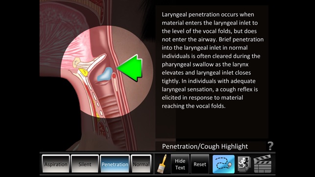 Aspiration Disorders(圖2)-速報App