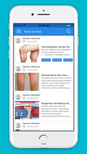 Varises Indonesia(圖2)-速報App