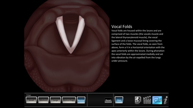 Vocal Pathology: Polyps(圖4)-速報App