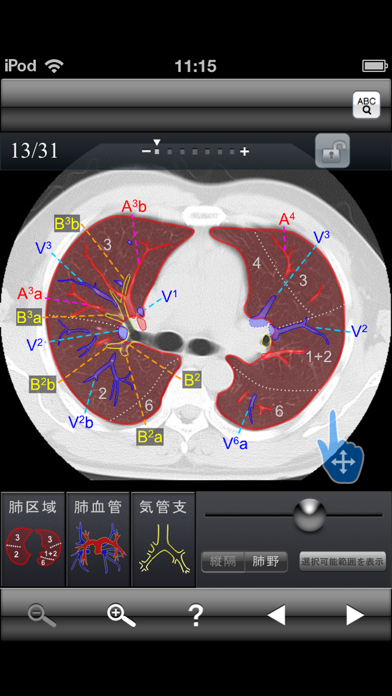 断面図ウォーカー胸部CT screenshot1