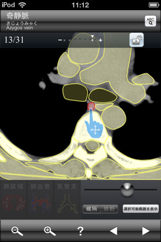 断面図ウォーカー胸部CT screenshot 4