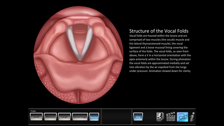 Vocal Pathology: Polyps screenshot-0