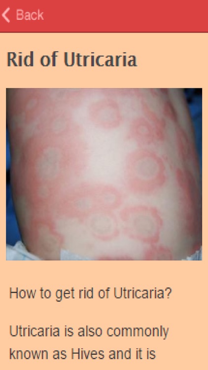 How To Get Rid Of Hives