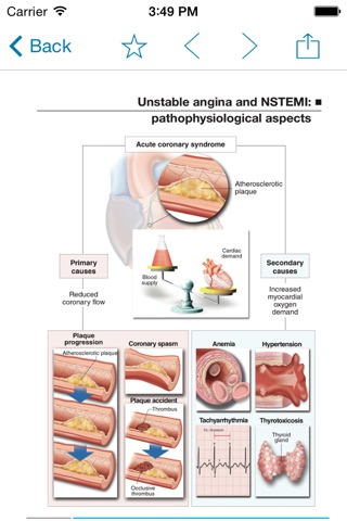 Miniatlas Acute Coronary Syndrome screenshot 2