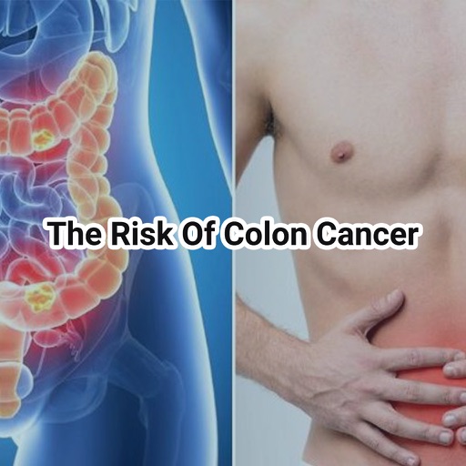 All Colon Cancer