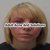 Adult acne and solutions