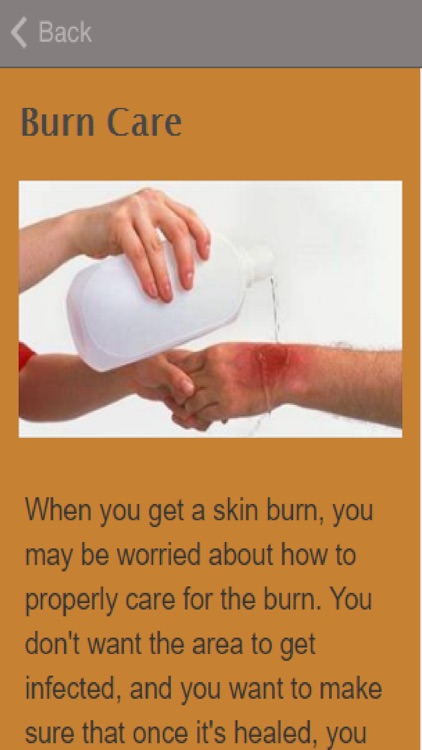 How To Treat Burns