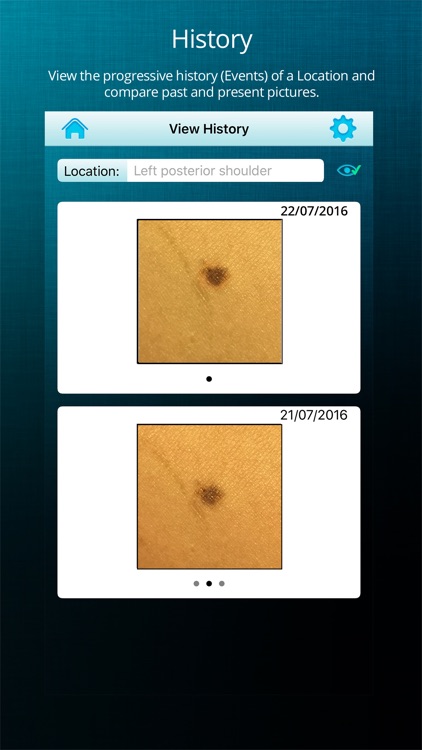 ApreSkin you - track your moles, skin cancers / melanoma and blemishes screenshot-3