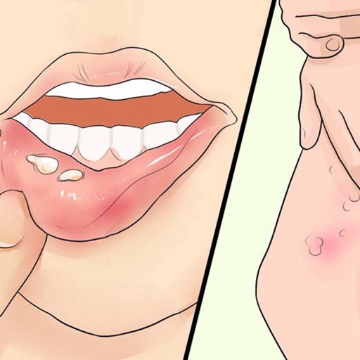 Herpes:Health Guide,Natural Remedies and Skin Diseases,Pain Management