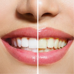 Teeth Whitening Tips - Learn How to Whiten Teeth