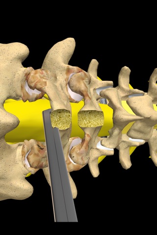 mLumbarLaminectomy screenshot 3