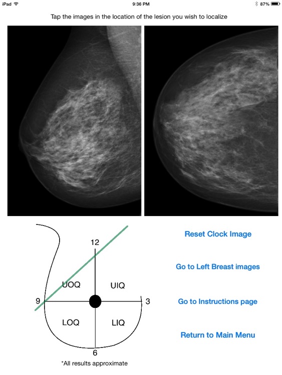 Mammography Localizer