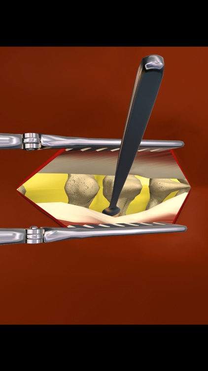 mLumbarLaminectomy
