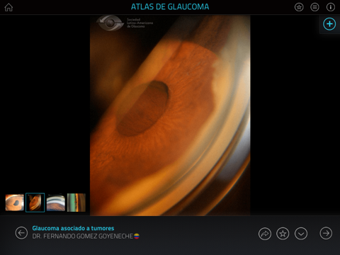 Atlas de Glaucoma screenshot 3