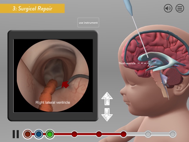 Hydrocephalus Procedure(圖3)-速報App