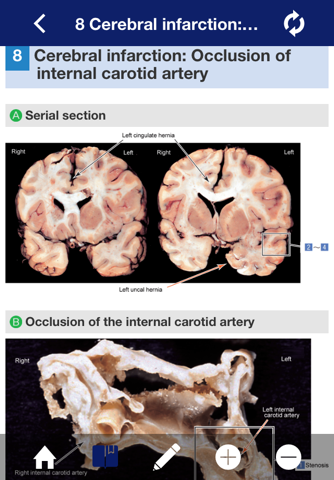 ATLAS OF PATHOLOGY And Comparison With Normal Anatomy Lite screenshot 2