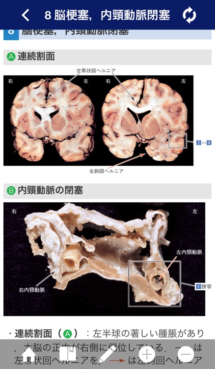 ATLAS OF PATHOLOGY And Comparison With Normal Anatomy