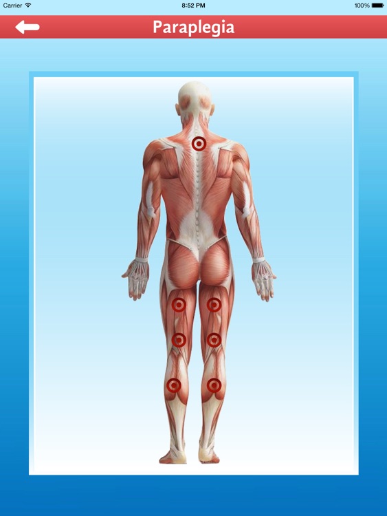 Cupping Therapy - Al Hijamah Preventive Medicine