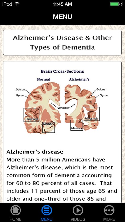 How to Avoid, Find & Cope with Alzheimer's Disease for Beginners to Experience - Understanding Alzheimer's Right screenshot-3