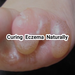 Curing Eczema