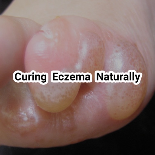 Curing Eczema icon