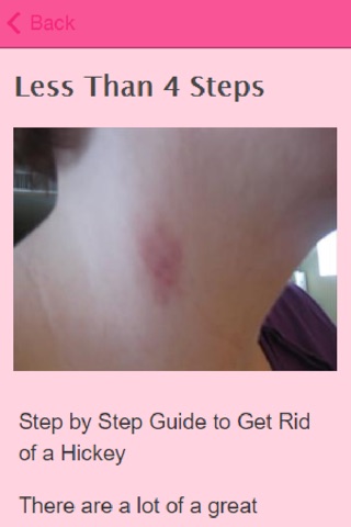 How To Get Rid Of Hickeys screenshot 2