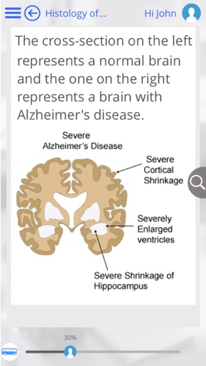 Alzheimer's and Parkinson's Disease by GoLearningBus(圖1)-速報App