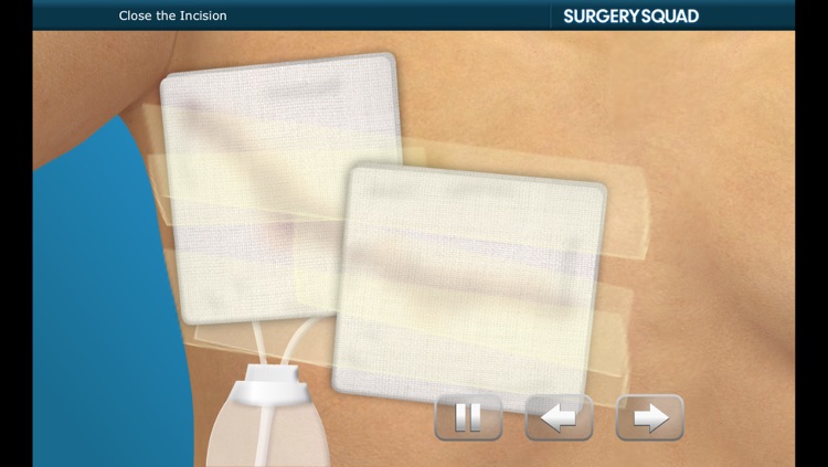 Surgery Squad's Mastectomy