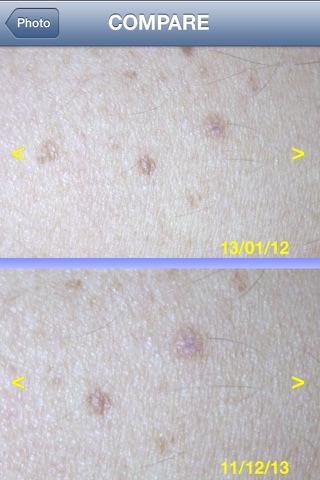 Skin Prevention – Photo Body Map for Melanoma and Skin Cancer early detection screenshot 4