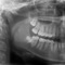 Panoramic radiographs provide a quick overview of the patient’s teeth, jaws, and bone