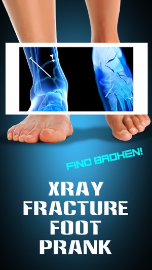 Xray Fracture Foot Prank(圖1)-速報App