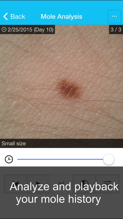 Skin Cancer App - MySkinPal - Map your skin moles
