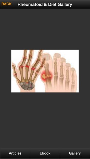 Rheumatoid Arthritis Guide - How To Relief Rheumatoid Arthri(圖4)-速報App