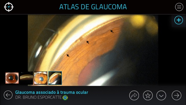 Atlas de Glaucoma para iPhone(圖3)-速報App