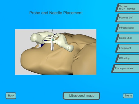 Regional Anesthesia Assistant for iPad screenshot 4