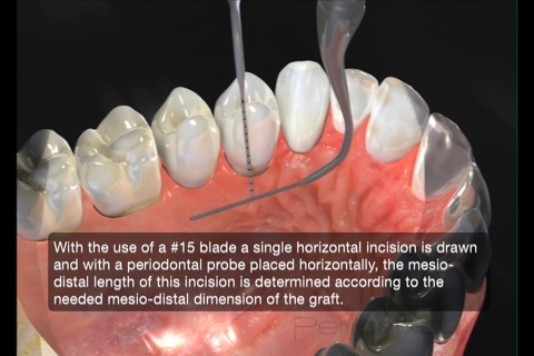 Periodontal Advanced Surgery By Mariano Sanz screenshot 4