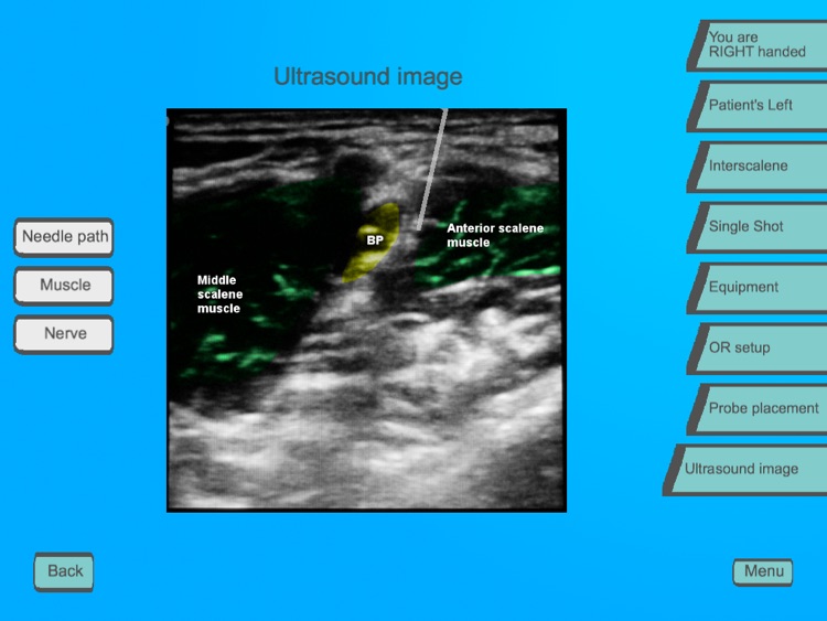 Regional Anesthesia Assistant for iPad