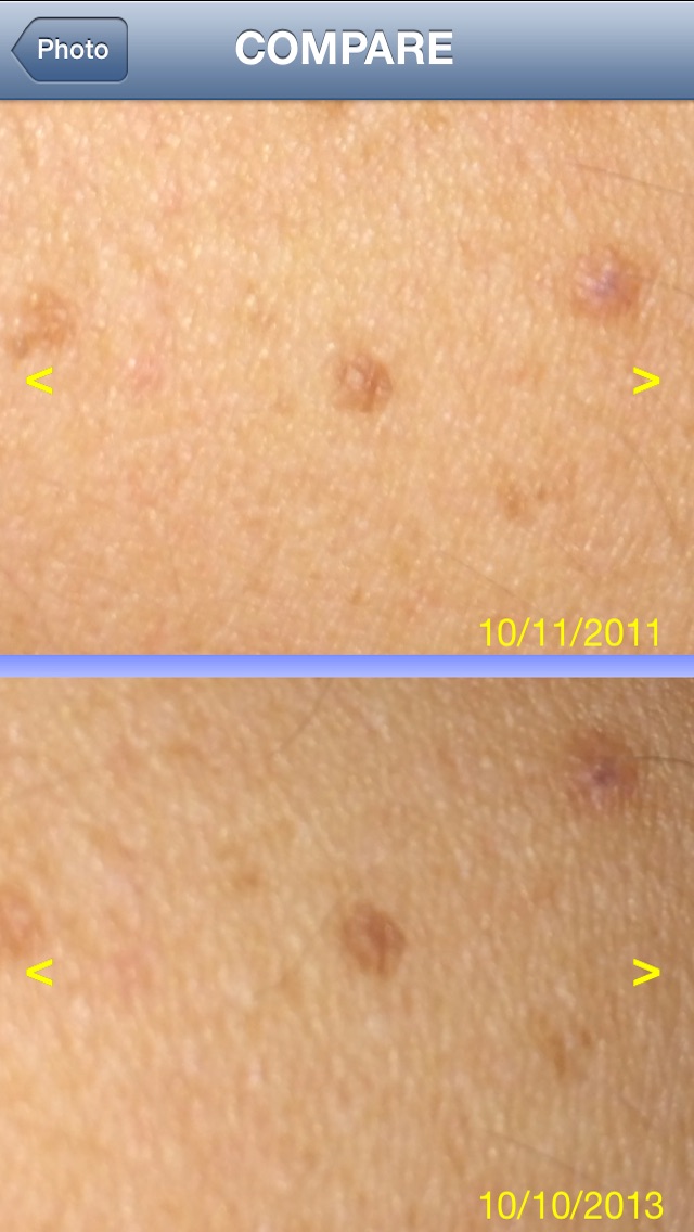 Skin Prevention – Photo Body Map for Melanoma and Skin Cancer early detection Screenshot 4