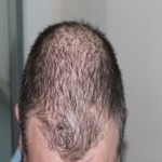 Hair Loss Treatment 1 Hair Loss Cure  Care