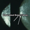 Know About Breast Cancer