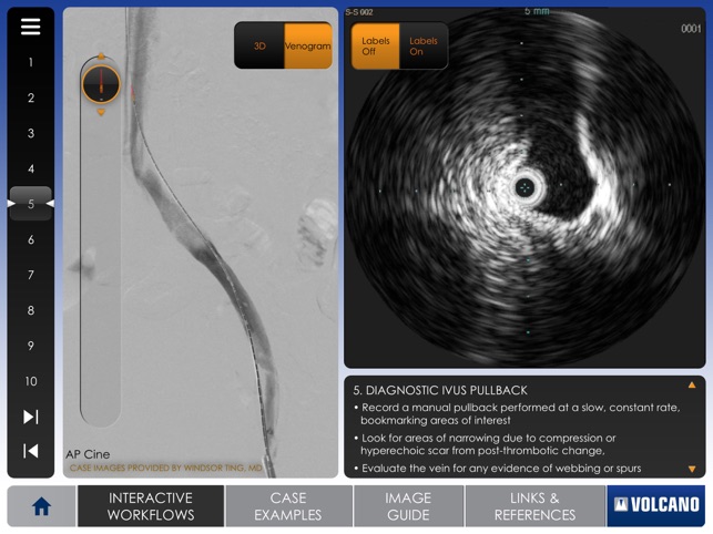 Venous IVUS(圖2)-速報App